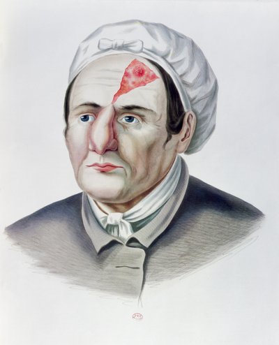 Após uma operação de enxerto de pele, da Selecta Praxis Medico-Chirurgica por Alexander Auvert, Paris, 1856 de French School