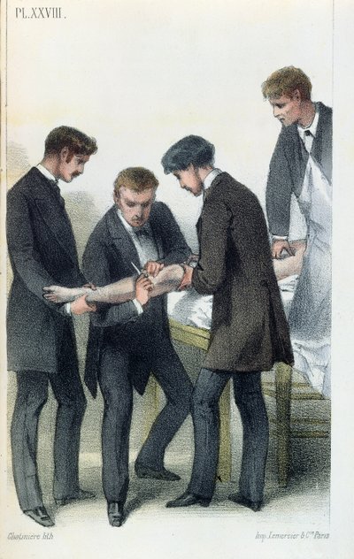 Amputando um braço, de um manual médico por Jean-Baptiste-Leon Dubreuil, c.1850-60 de French School