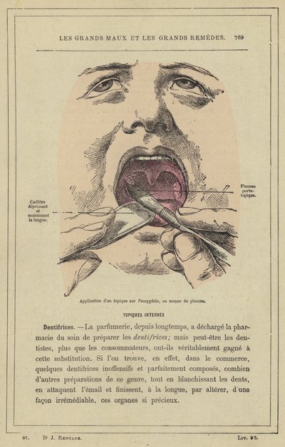 Aplicação de um tópico sobre a amígdala, utilizando o pincel (cor litho) de French School