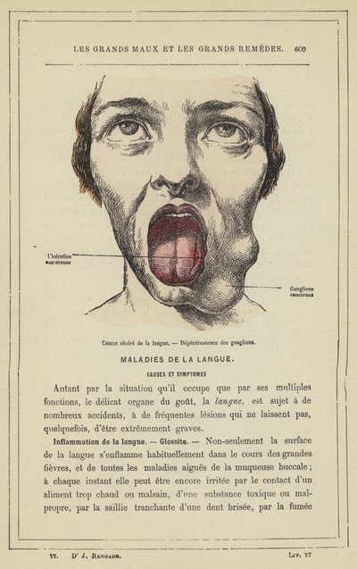 Úlcera de língua cancerígena, Degeneração do nó (cor litho) de French School