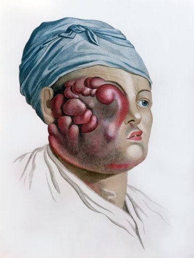 Scrofula cancerosa, da descrição das doenças da pele pelo barão Jean Louis Alibert (1768-1837) Paris, 1806 de French School