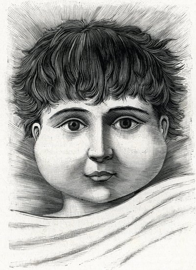 Criança com doença da papeira (gravura) 1888 de French School