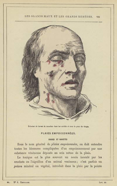 Incubação de larvas de mosca nas cavidades e sob a pele do rosto (cor litho) de French School