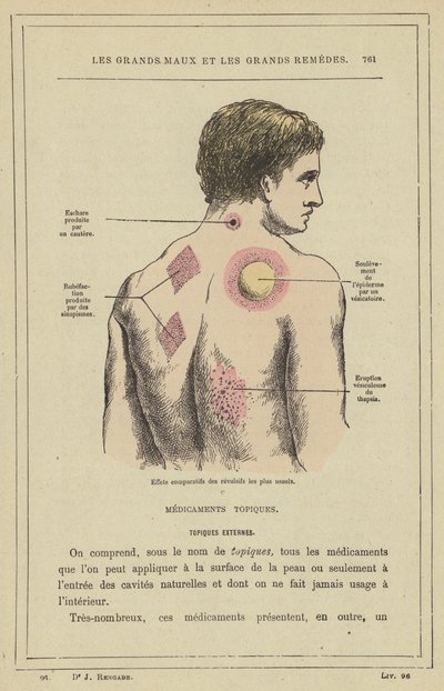 Efeitos comparativos dos revulsivos mais comuns (cor litho) de French School