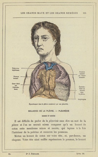 Efusão na pleura causada por uma pleurisia (cor litho) de French School