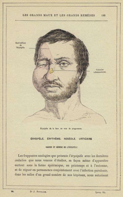 Erysipelas do rosto em progresso (cor litho) de French School