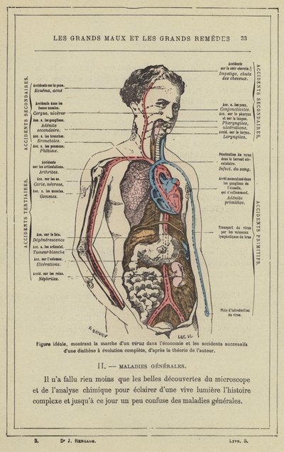 Figura ideal, mostrando a marcha de um vírus na economia e os sucessivos acidentes de uma diátese com evolução completa, de acordo com a teoria do autor (cor litho) de French School