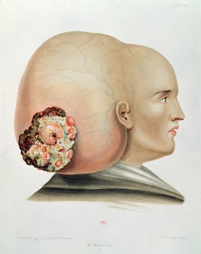 Fungo da dura-máter, de Selecta Praxis Medico-Chirurgica por Alexander Auvert, Paris, 1856 de French School