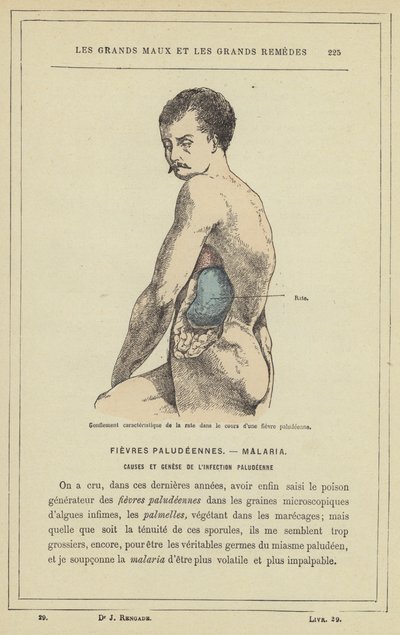 Inchaço característico do baço no decurso de uma febre malária (cor litho) de French School