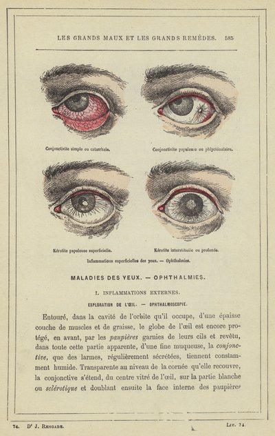 Inflamação superficial dos olhos, Ophthalmia (cor litho) de French School