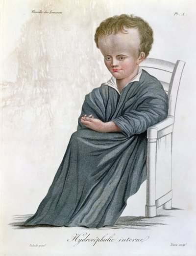 Hidrocefalia interna, de Nosologie Naturelle, do barão Jean Louis Alibert (1768-1837) gravada por Tresca, 1817 de French School