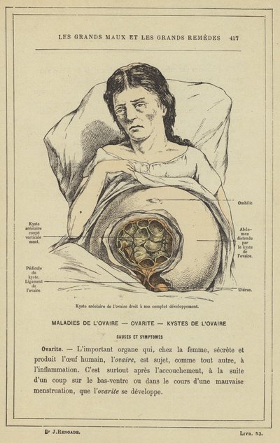 Cisto areolar do ovário direito em seu pleno desenvolvimento (cor litho) de French School