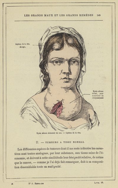 Cisto seroso do pescoço, lipoma da cabeça (cor litho) de French School