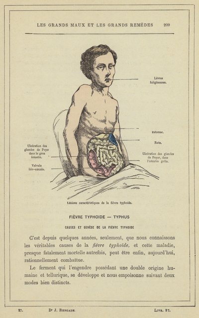 Lesões características da febre tifóide (cor litho) de French School