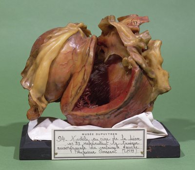 Modelo de um tumor do ventrículo esquerdo, 1799 (cera) de French School