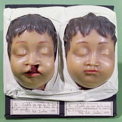 Modelo mostrando o rosto de uma criança antes e depois de uma operação para corrigir uma lipoide realizada por Antoine Dubois (1756-1837) em 1799 (cera) de French School