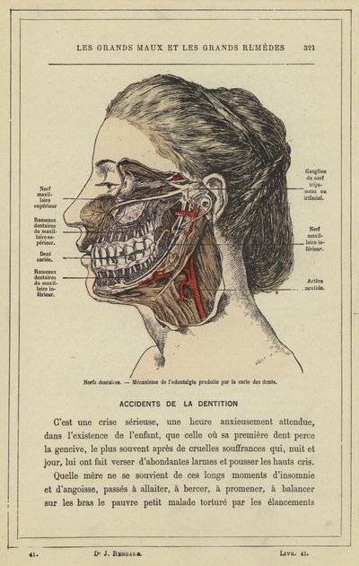 Nervos dentários, Mecanismo de odontologia produzido pela cárie dentária (cor litho) de French School