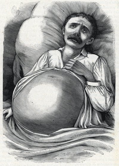 Paciente com cirrose hepática avançada (gravura) 1888 de French School