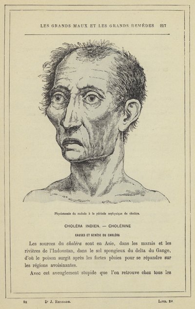 Fisiognomia do paciente durante o período de asfixia da cólera (cor litho) de French School