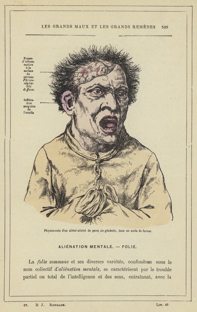 Fisiognomia de um estrangeiro que sofre de paralisia geral, em um ataque de raiva (cor litho) de French School