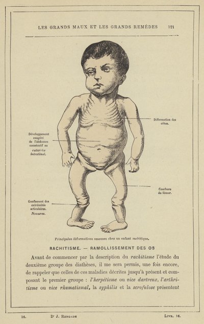 Principais deformações ósseas de uma criança com raquitismo (cor litho) de French School