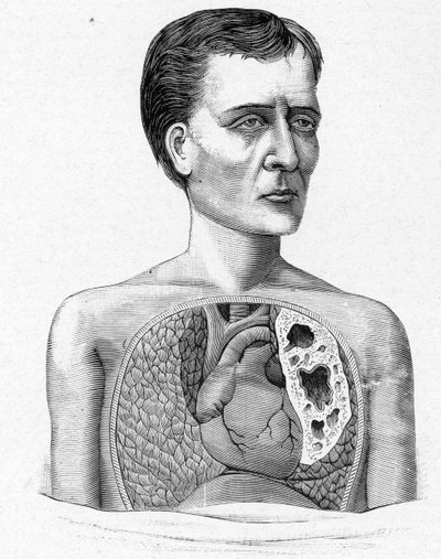 Representação de uma pessoa com grutas, complicação da tuberculose (gravura) de French School