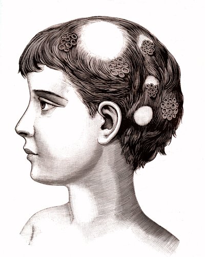 Micose numa criança. 1887 (gravura) de French School