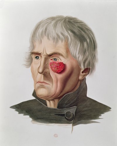 Doença de pele antes de uma operação, de Selecta Praxis Medico-Chirurgica por Alexander Auvert, Paris, 1856 de French School