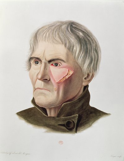Operação de enxerto de pele, da Selecta Praxis Medico-Chirurgica por Alexander Auvert, Paris, 1856 de French School