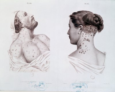 Sintomas da sífilis em homens e mulheres, de um livro médico, c.1850-60 de French School