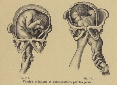 Entregando os pés de um bebê primeiro (parto pélvico) de German School