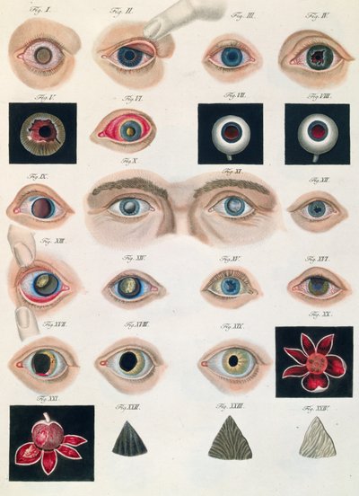 Descrição das anomalias congênitas dos olhos, de Representações Clínicas de Doenças e Erros Cegantes do Olho Mesnschlichen, de Friedrich August von Ammon (1799-1861) 1838 de German School