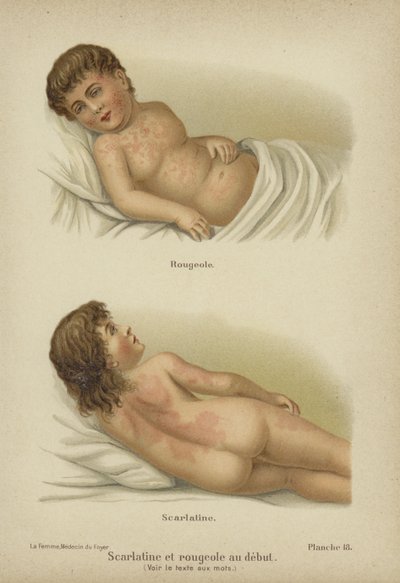 Sintomas precoces de sarampo e escarlatina (cor litho) de German School