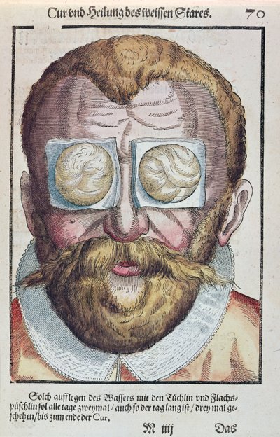 Tratar de uma condição de olho, de Ophthalmodouleia por Georg Bartisch (1535-1636) publicou em Dresden em 1583 (impressão de woodblock de cor) de German School