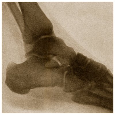 Raio X de um tornozelo c.1890 de German School