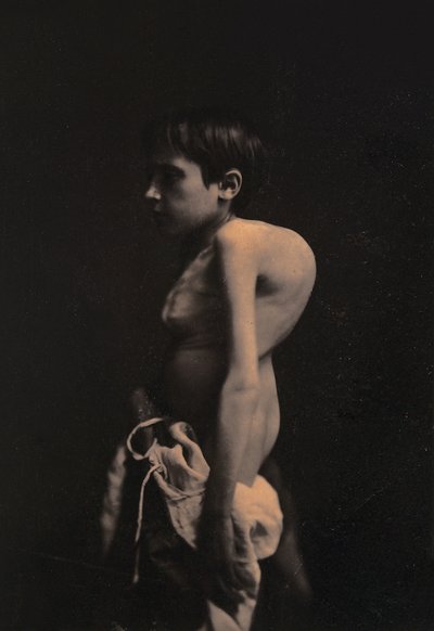 Retrato de um menino corcunda, c.1855-57 de Guillaume-Benjamin-Armand Duchenne de Boulogne
