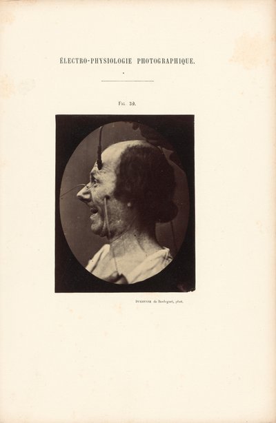 Eletrofisiologia fotográfica, Figura 39 de Guillaume Benjamin Duchenne
