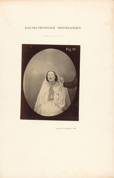 Eletrofisiologia fotográfica, Figura 76 de Guillaume Benjamin Duchenne