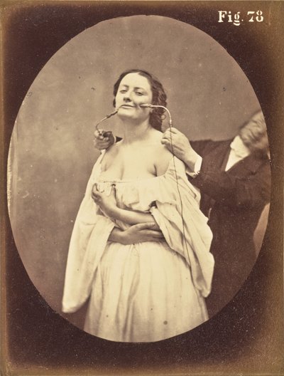Fig. 78 de Guillaume Benjamin Duchenne