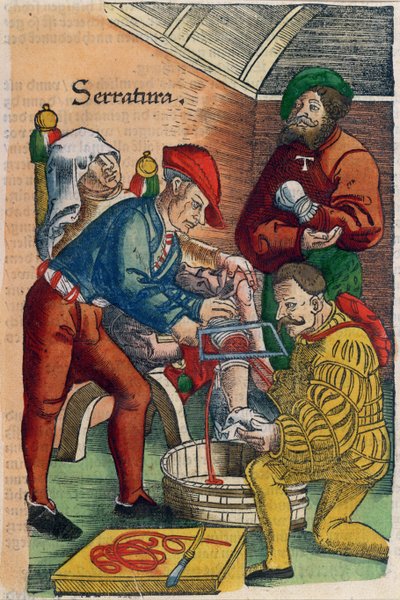Uma amputação, ilustração de &39;Feldartbuch der Wundartzney&39; por Hans von Gersdorff, c.1540 (impressão em xilogravura a cores) de Hans or Johannes Ulrich Wechtlin