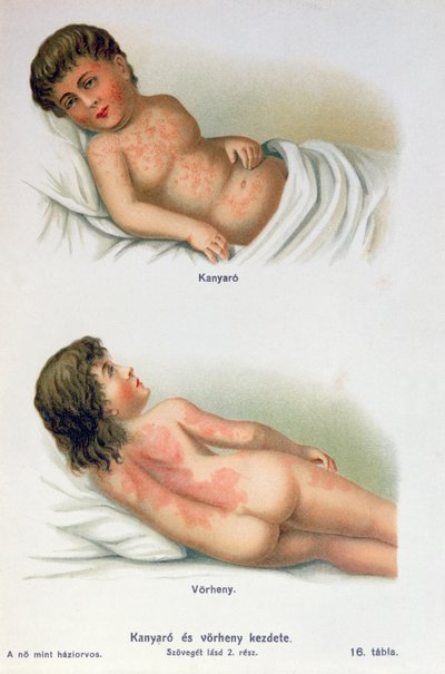 Sarampo e febre escarlate, de um livro médico de família, c.1900 de Hungarian School