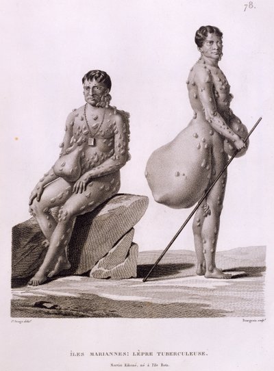 Ilhas Marianas do Norte: Dois Homens Sofrendo de Tuberculose, de &39;Viagem ao Redor do Mundo nas Corvetas de Urania 1817-20&39; gravado por Bourgeois, publicado em 1825 de Jacques Etienne Victor Arago