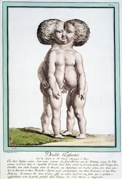 Crianças siamesas - em "Os Desvios da Natureza" de Régnault de Jean Baptiste Regnault