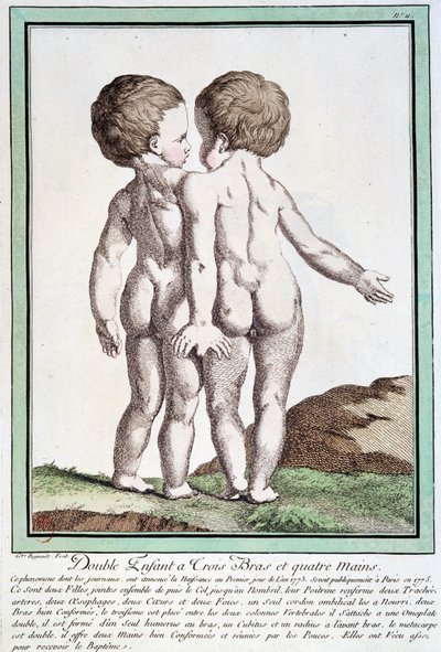 Crianças siamesas - em "Les desvios de la nature" de Régnault de Jean Baptiste Regnault