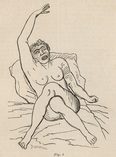 Epilepsia histérica, ataque, contorções, figo. 1 de &39;Iconografia fotográfica de La Salpetriere&39; de Bourneville e P. Regnard, Paris, 1876 de Jean Francois Badoureau