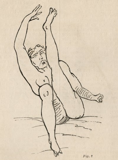 Epilepsia histérica, ataque, contorções, figo. 2 de &39;Iconografia fotográfica de La Salpetriere&39; de Bourneville e P. Regnard, Paris, 1876 de Jean Francois Badoureau