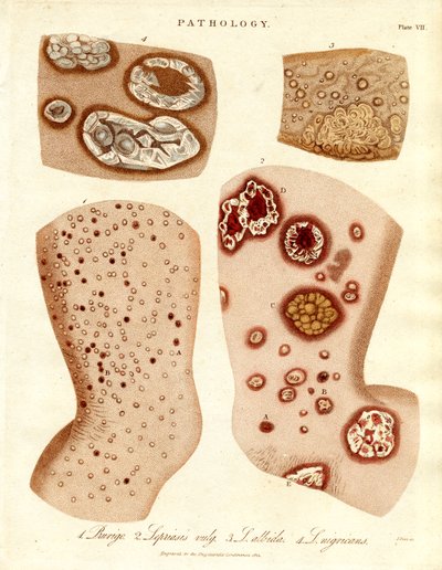 Condições patológicas da pele: Schurigie; Pele leprosa; Pallada e Impetigo de John Pass