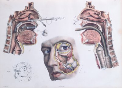 Operação Nasal, placa de &39;Tratado Completo da Anatomia do Homem&39; de Jean-Baptiste Marc Bourgery (1797-1849) 1866-67 de Nicolas Henri Jacob