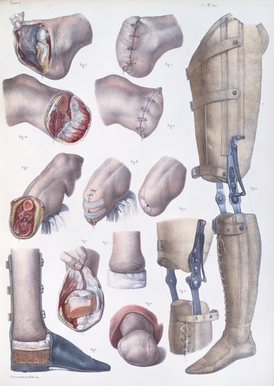 Amputações e próteses, placa do "Tratado Completo sobre a Anatomia do Homem", de Jean-Baptiste Marc Bourgery (1797-1849) 1866-67 de Nicolas Henri Jacob