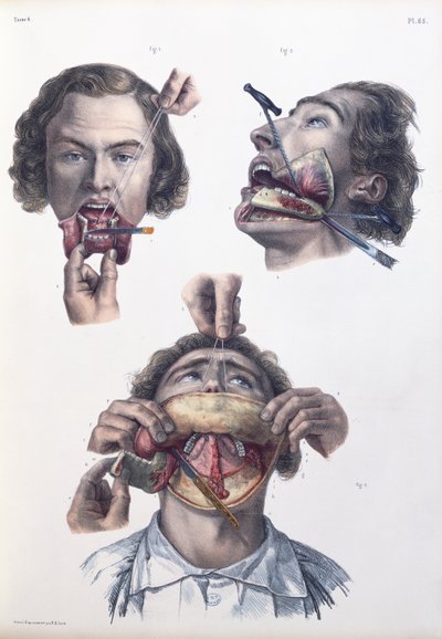 Operação no maxilar inferior, placa de "Traço Completo da Anatomia do Homem" por Jean-Baptiste Marc Bourgery (1797-1849) 1866-67 de Nicolas Henri Jacob